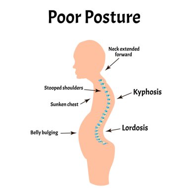 Uygunsuz duruş belirtileri. Metin Boyun Sendromu. Omurga eğriliği, kifoz, lordosis, skolyoz, artrosis. Uygunsuz duruş ve eğilme. Bilgi grafikleri. İzole edilmiş arkaplanda vektör illüstrasyonu.