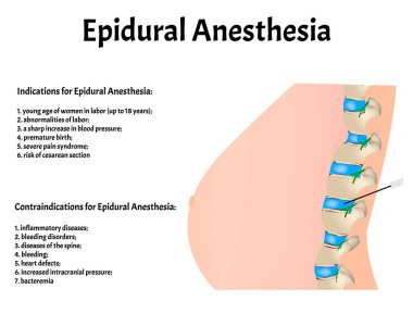Epidural anesthesia during childbirth. Epidural anesthesia of pregnant women. Indications and contraindications. Vector illustration clipart