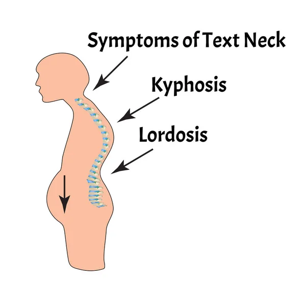 The position of the spine with lordosis, kyphosis. Text Neck Syndrome. Spinal curvature, kyphosis, lordosis, scoliosis, arthrosis. Poor posture and slouching. Infographics. Vector illustration. — Stock Vector