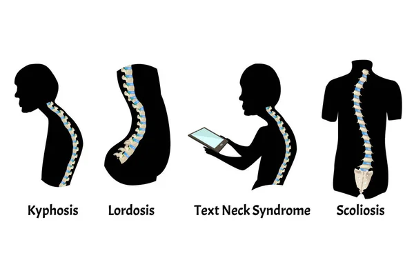 Pozice páteře s lordosis, kyphosis. Syndrom textového krku. Zakřivení páteře, kyfóza, lordosa, skolióza, artróza. Špatné držení těla a hrbení. Infographics. Vektorová ilustrace. — Stockový vektor