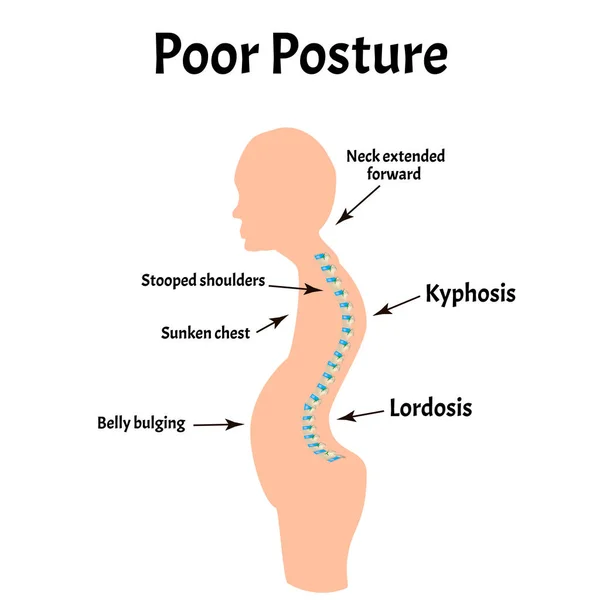 Improper posture symptoms. Text Neck Syndrome. Spinal curvature, kyphosis, lordosis, scoliosis, arthrosis. Improper posture and stoop. Infographics. Vector illustration on isolated background.