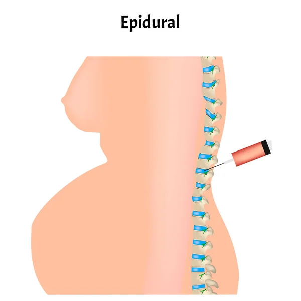 Epidurální anestezie během porodu. Epidurální anestezie těhotných žen. Vektorová ilustrace. — Stockový vektor