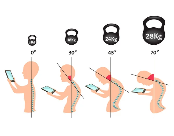 Nesprávné příznaky držení těla. Syndrom Stage Text Neck. Zakřivení páteře, kyfóza, lordosa, skolióza, artróza. Nesprávný postoj a sehnout se. Infographics. Vektorová ilustrace na izolovaném pozadí. — Stockový vektor