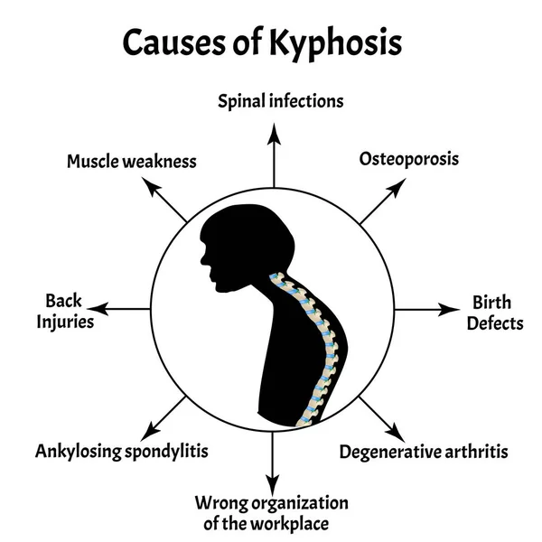 Causes of kyphosis. Spinal curvature, kyphosis, lordosis, scoliosis, arthrosis. Poor posture and slouching. Infographics. Vector illustration on isolated background. — Stock Illustration Causes of kyphosis. Spinal curvature, kyphosis, lordosis, scoliosis, arthrosis. Poor posture and slouching. Infographics. Vector illustration on isolated background. Royalty Free Stock Vectors