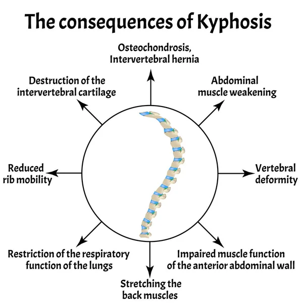 The consequences of kyphosis. Spinal curvature, kyphosis, lordosis, scoliosis, arthrosis. Improper posture and stoop. Infographics. Vector illustration on isolated background. — Stock Illustration The consequences of kyphosis. Spinal curvature, kyphosis, lordosis, scoliosis, arthrosis. Improper posture and stoop. Infographics. Vector illustration on isolated background. Royalty Free Stock Illustrations