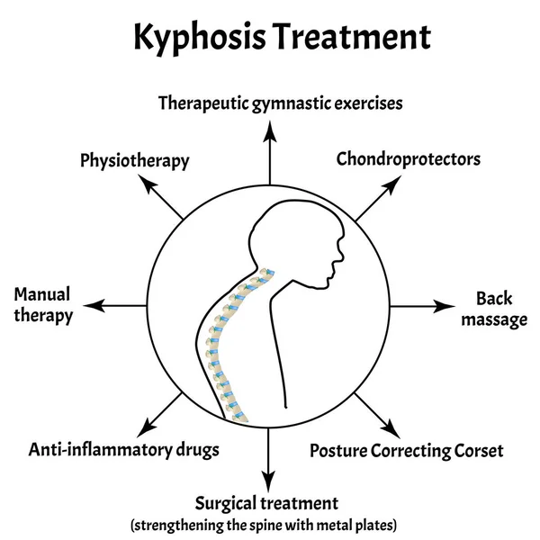 Kyphosis treatment. Spinal curvature, kyphosis, lordosis, scoliosis, arthrosis. Improper posture and stoop. Infographics. Vector illustration on isolated background. — Stock Illustration Kyphosis treatment. Spinal curvature, kyphosis, lordosis, scoliosis, arthrosis. Improper posture and stoop. Infographics. Vector illustration on isolated background. Stock Illustration