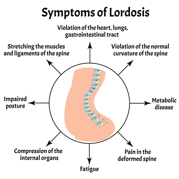 Symptoms of lordosis. Spinal curvature, kyphosis, lordosis, scoliosis, arthrosis. Improper posture and stoop. Infographics. Vector illustration on isolated background. — Stock Illustration Symptoms of lordosis. Spinal curvature, kyphosis, lordosis, scoliosis, arthrosis. Improper posture and stoop. Infographics. Vector illustration on isolated background. Royalty Free Stock Illustrations