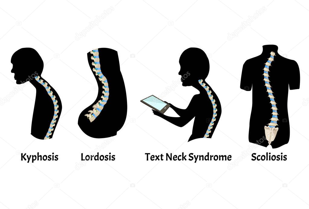 The position of the spine with lordosis, kyphosis. Text Neck Syndrome. Spinal curvature, kyphosis, lordosis, scoliosis, arthrosis. Poor posture and slouching. Infographics. Vector illustration.