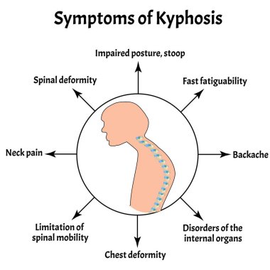 Kyphosis belirtileri. Omurga eğriliği, kifoz, lordosis, skolyoz, artrosis. Uygunsuz duruş ve eğilme. Bilgi grafikleri. İzole edilmiş arkaplanda vektör illüstrasyonu.