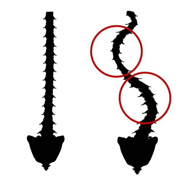 Schwarz-weiße Silhouette Ikone Skoliose. Wirbelsäulenverkrümmung, Kyphose, Lordose des Halses, Skoliose, Arthrose. Fehlhaltung und Verbeugung. Infografik Vektorillustration auf isoliertem Hintergrund. — Stockvektor