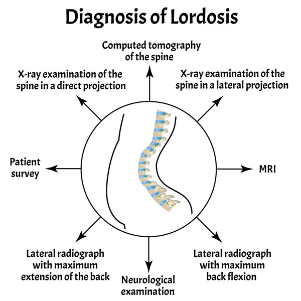 Diagnosis of lordosis. Spinal curvature, kyphosis, lordosis, scoliosis, arthrosis. Improper posture and stoop. Infographics. Vector illustration on isolated background. — Stock Illustration Diagnosis of lordosis. Spinal curvature, kyphosis, lordosis, scoliosis, arthrosis. Improper posture and stoop. Infographics. Vector illustration on isolated background. Stock Vector