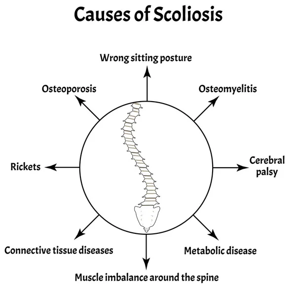 Causes of Scoliosis. Spinal curvature, kyphosis, lordosis of the neck, scoliosis, arthrosis. Improper posture and stoop. Infographics. Vector illustration on isolated background. — Stock Illustration Causes of Scoliosis. Spinal curvature, kyphosis, lordosis of the neck, scoliosis, arthrosis. Improper posture and stoop. Infographics. Vector illustration on isolated background. Stock Illustration