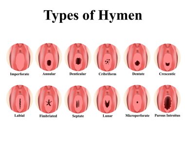 Kızlık zarı tipi. Delinmemiş, dairesel, dişçi, kribriform, dentate, Crescentic, Labial, Fimbriated, Septate, Microperforate. Kızlık zarını dezenfekte ettikten sonra. Bilgi grafikleri. Vektör illüstrasyonu.