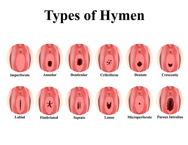 Typer av mödomshinnan. Imperforat, ringformig, Denticular, Krimform, protes, Krescentic, Labial, Fimbriated, and, lunar, Microperforate. Hymen efter defloration. Infografik. Vektorillustration. — Stock vektor