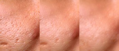 Comparison of skin before and after laser resurfacing. Skin with acne, acne scars, enlarged pores. clipart