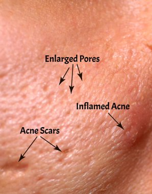 Skin with acne, acne scars, enlarged pores. clipart