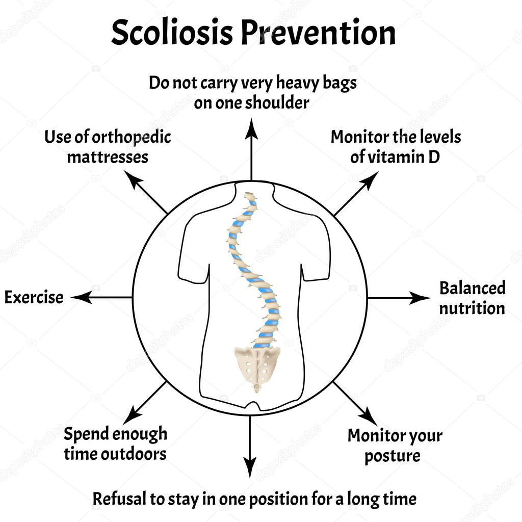Prevention of Scoliosis. Spinal curvature, kyphosis, lordosis of the neck, scoliosis, arthrosis. Improper posture and stoop. Infographics. Vector illustration on isolated background.