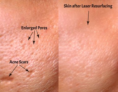 Comparison of skin before and after laser resurfacing. Skin with acne, acne scars, enlarged pores. clipart