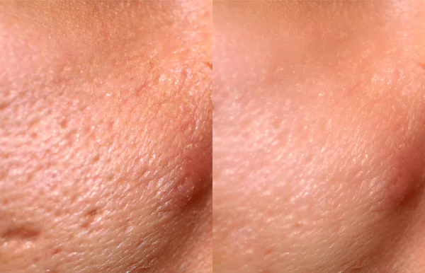 Porovnání kůže před a po znovuobjevení laserem. Kůže s akné, jizvy po akné, rozšířené póry. — Stock fotografie
