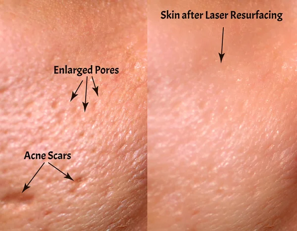 Vergelijking van de huid voor en na laser resurfacing. Huid met acne, acne littekens, vergrote poriën. — Stockfoto