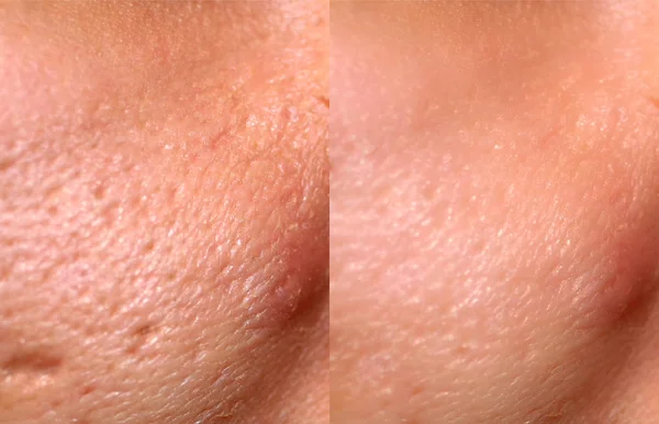 Comparaison De La Peau Avant Et Après Le Resurfaçage Au Laser. Peau Avec Acné, Cicatrices D'Acné, Pores Dilatés . — Photo