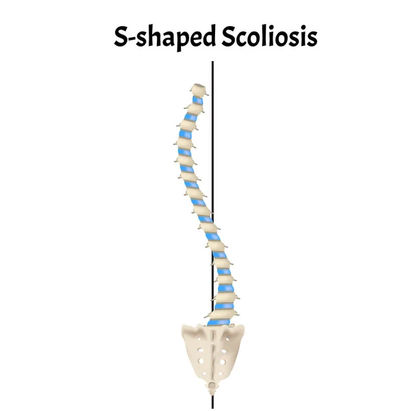 S-vormige scoliose. Dextroscoliose. Levoscoliose. Spinale kromming, kyphose, lordose, scoliose, artrose. Infografieën. Vectorillustratie op geïsoleerde achtergrond. — Stockvector