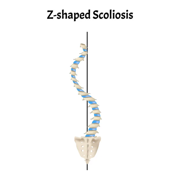 Z-shaped scoliosis. Dextroscoliosis. Levoscoliosis. Spinal curvature, kyphosis, lordosis, scoliosis, arthrosis. Infographics. Vector illustration on isolated background. — Stock Vector