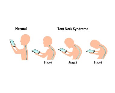 Improper posture symptoms. Stage Text Neck Syndrome. Spinal curvature, kyphosis, lordosis, scoliosis, arthrosis. Improper posture and stoop. Infographics. Vector illustration on isolated background. clipart