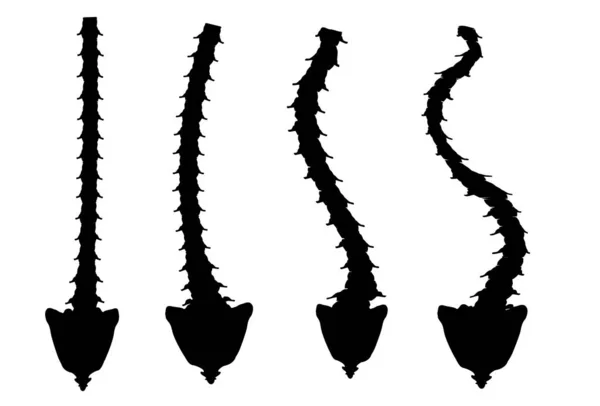 Tipos de escoliosis. Escoliosis en forma de C, S, Z. Dextroescoliosis. Levoscoliosis. Curvatura espinal, cifosis, lordosis, artrosis. Infografías. Ilustración vectorial sobre fondo aislado . — Vector de stock