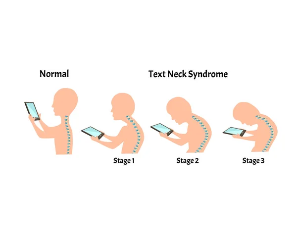 Nesprávné příznaky držení těla. Syndrom Stage Text Neck. Zakřivení páteře, kyfóza, lordosa, skolióza, artróza. Nesprávný postoj a sehnout se. Infographics. Vektorová ilustrace na izolovaném pozadí. — Stockový vektor