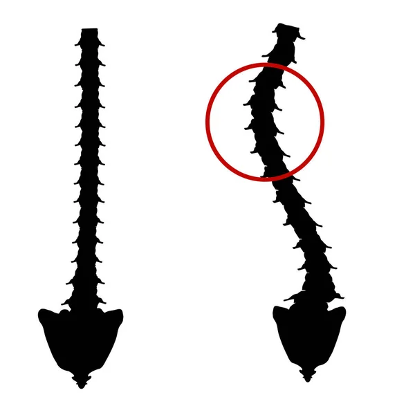 Černá a bílá silueta ikona skolióza. Zakřivení páteře, kyfóza, lordosa krku, skolióza, artróza. Nesprávný postoj a sehnout se. Infographics Vector illustration on isolated background. — Stockový vektor