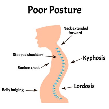 Uygunsuz duruş belirtileri. Metin Boyun Sendromu. Omurga eğriliği, kifoz, lordosis, skolyoz, artrosis. Uygunsuz duruş ve eğilme. Bilgi grafikleri. İzole edilmiş arkaplanda vektör illüstrasyonu.