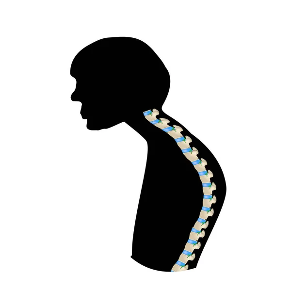 De positie van de wervelkolom met kyphosis. Zwart-wit silhouet icoon. Spinale kromming, kyphose, lordose, scoliose, artrose. Onjuiste houding en bukken. Infografieën. Vectorillustratie. — Stockvector