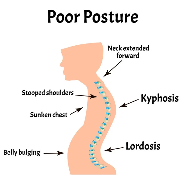 Improper posture symptoms. Text Neck Syndrome. Spinal curvature, kyphosis, lordosis, scoliosis, arthrosis. Improper posture and stoop. Infographics. Vector illustration on isolated background. — Stock Illustration Improper posture symptoms. Text Neck Syndrome. Spinal curvature, kyphosis, lordosis, scoliosis, arthrosis. Improper posture and stoop. Infographics. Vector illustration on isolated background. Stock Illustration