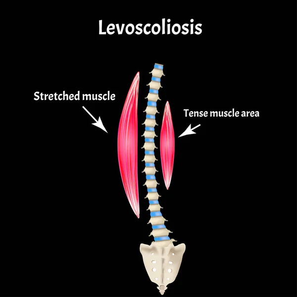 Escoliosis del lado izquierdo. Levoscoliosis. Músculos y columna vertebral. Curvatura espinal en escoliosis. Infografías. Ilustración vectorial . — Vector de stock