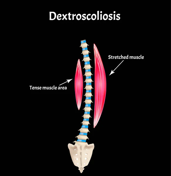 Skoliose Dextroskoliose. Wirbelsäulenverkrümmung, Kyphose, Lordose, Skoliose, Arthrose. Infografiken. Vektorillustration. — Stockvektor