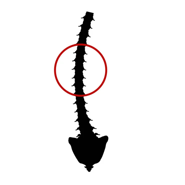 Ícone de silhueta preto e branco escoliose. Curvatura espinhal, cifose, lordose do pescoço, escoliose, artrose. Postura e inclinação inadequadas. Infográficos Ilustração vetorial em fundo isolado . — Vetor de Stock