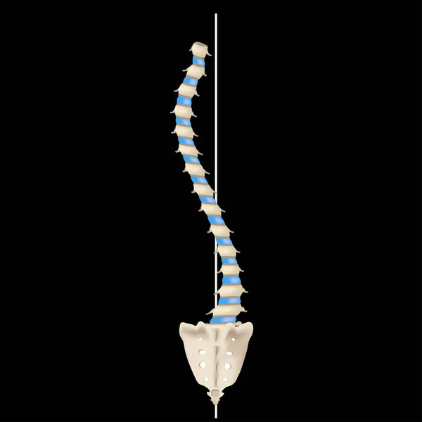 S-shaped scoliosis. Dextroscoliosis. Levoscoliosis. Spinal curvature, kyphosis, lordosis, scoliosis, arthrosis. Infographics. Vector illustration. — 스톡 벡터