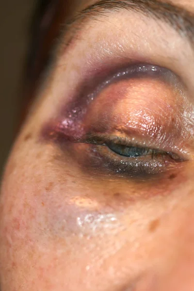 A bruise near the eye. Hematoma on the face from a blow. Eye injury. — Stock Photo, Image