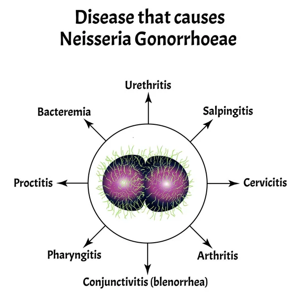 Gonococcus yapısı. Neisseria belsoğukluğuna neden olan hastalık. Belsoğukluğu hastalığı. Zührevi hastalık. Cinsel yolla bulaşan hastalıklar. Bilgi grafikleri. İzole edilmiş arkaplanda vektör illüstrasyonu. — Stok Vektör