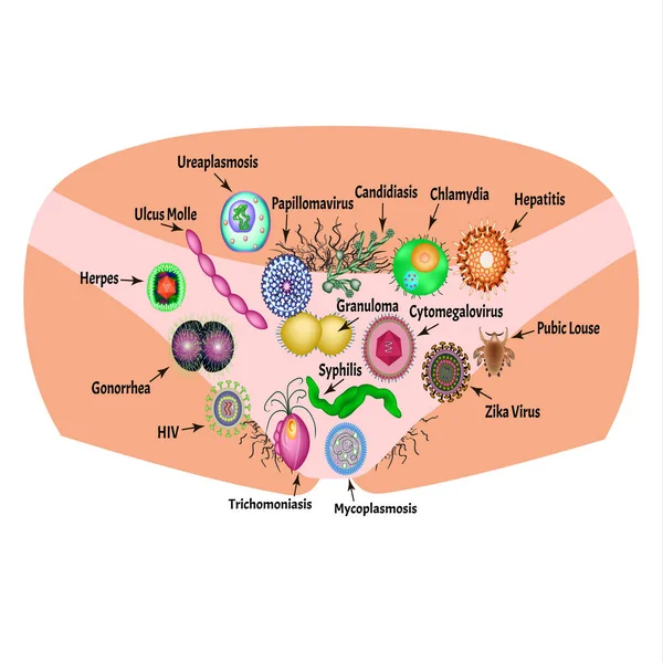 Infections virales et bactériennes. Maladies sexuellement transmissibles. Infographie. Illustration vectorielle sur fond isolé . — Image vectorielle