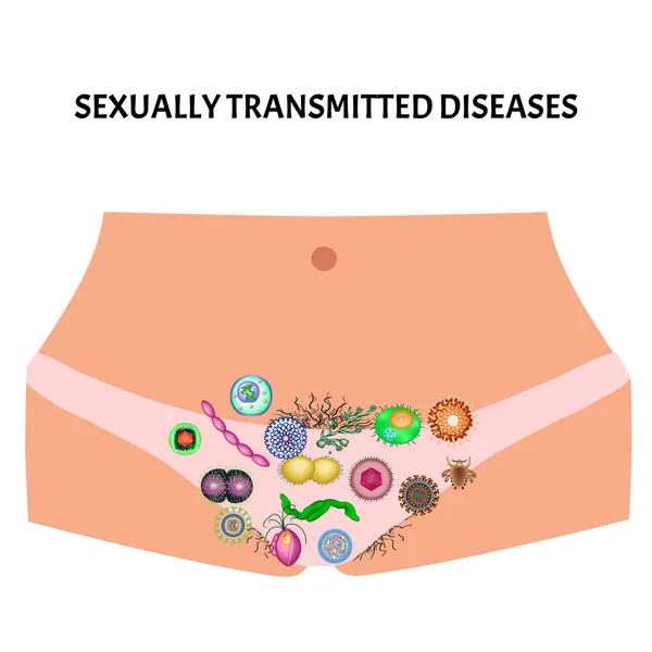 Vírusos és bakteriális fertőzések. Szexuális úton terjedő betegségek. Infografikák. Vektorillusztráció izolált háttérrel. — Stock Vector