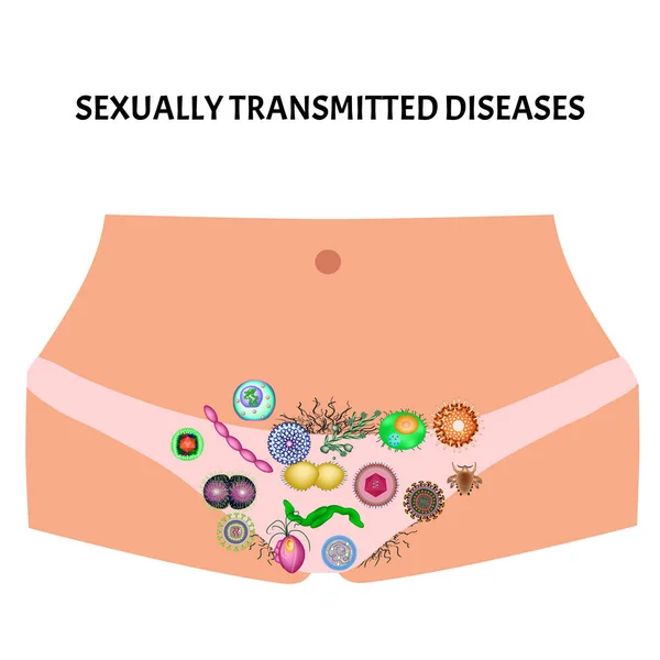 病毒和细菌感染。性传染疾病。信息图形。孤立背景下的矢量说明. — 图库矢量图片