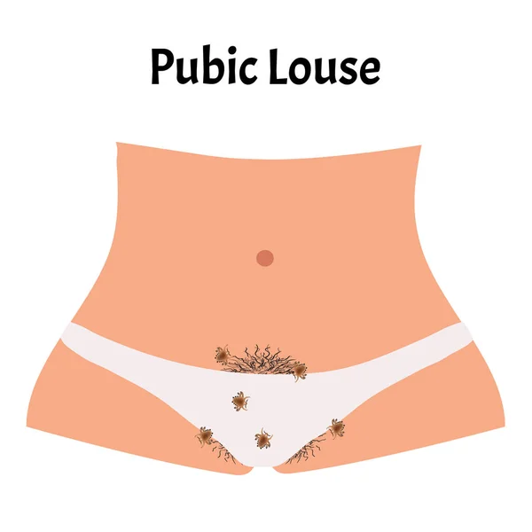 Malattie parassitarie della Fitiriasi. Pediculosi pube. Struttura dei pidocchi pubici. Malattie a trasmissione sessuale. Infografica. Illustrazione vettoriale su sfondo isolato . — Vettoriale Stock