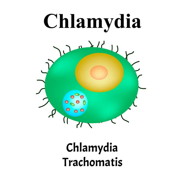 Chlamydia trachomatis Бактеріальні інфекції Хламідіоз. Статево-передані хвороби. Інфографіка. Вікторна ілюстрація на ізольованому тлі. — стоковий вектор