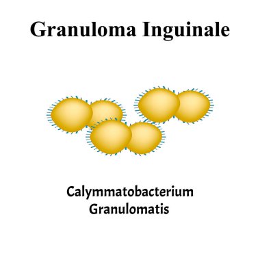 İnguinal granülom. Bakteriyel enfeksiyonlar. Cinsel yolla bulaşan hastalıklar. Bilgi grafikleri. İzole edilmiş arkaplanda vektör illüstrasyonu.