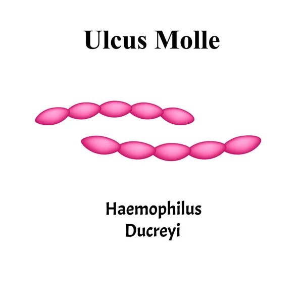 Ulcus Molle, Haemophilus ducreyi. Infecciones bacterianas. Enfermedades de transmisión sexual. Infografías. Ilustración vectorial sobre fondo aislado . — Vector de stock
