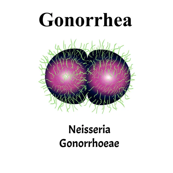 Gonococcus struktúra. Neisseria gonorrhoeák. Gonorrhea betegség. Venereális betegség. Infografikák. Vektorillusztráció izolált háttérrel. — Stock Vector