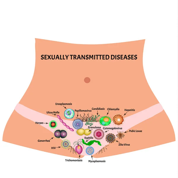 Infecciones virales y bacterianas. Enfermedades de transmisión sexual. Infografías. Ilustración vectorial sobre fondo aislado . — Vector de stock