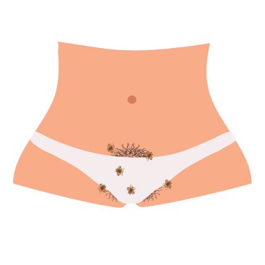 Phthiriasis 'in parazit hastalıkları. Pediküloz kasık kemiği. Kasık biti yapısı. Cinsel yolla bulaşan hastalıklar. Bilgi grafikleri. İzole edilmiş arkaplanda vektör illüstrasyonu.